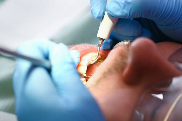 Best Emergency Dental Care for Broken or Chipped Teeth in Atlantis, FL